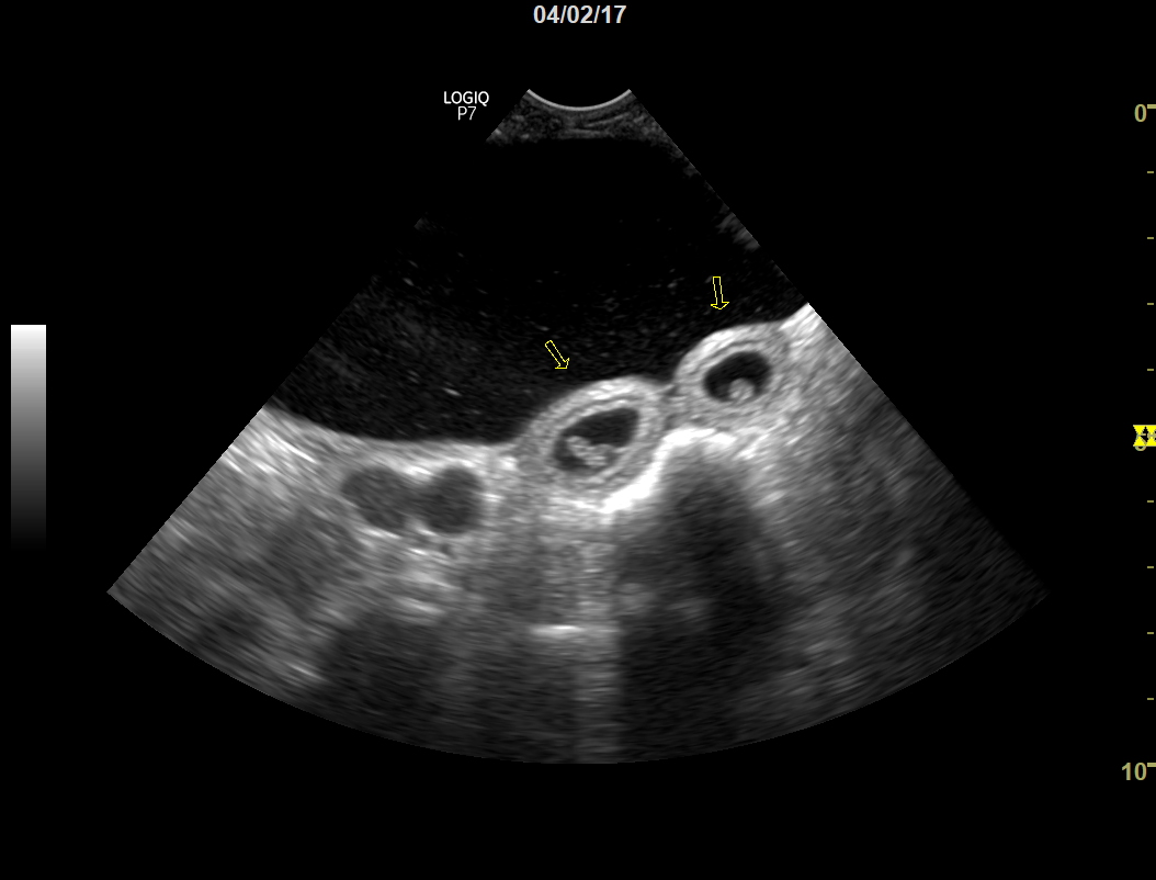 Ultralyd foserblere.jpg